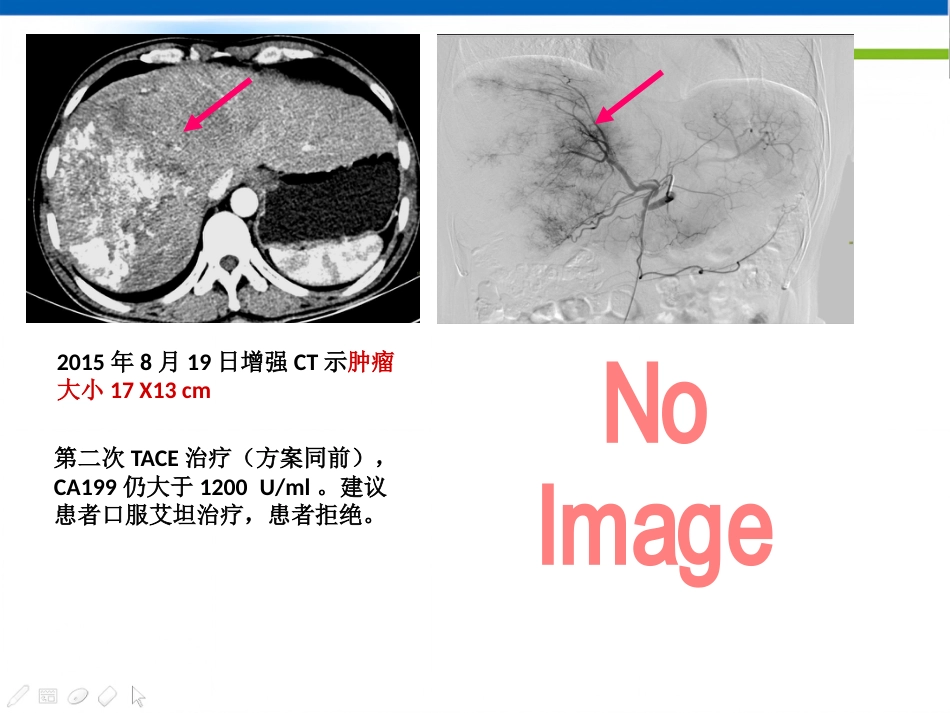 肝癌分子靶向治疗-郑传胜肝癌研讨会幻灯_第13页