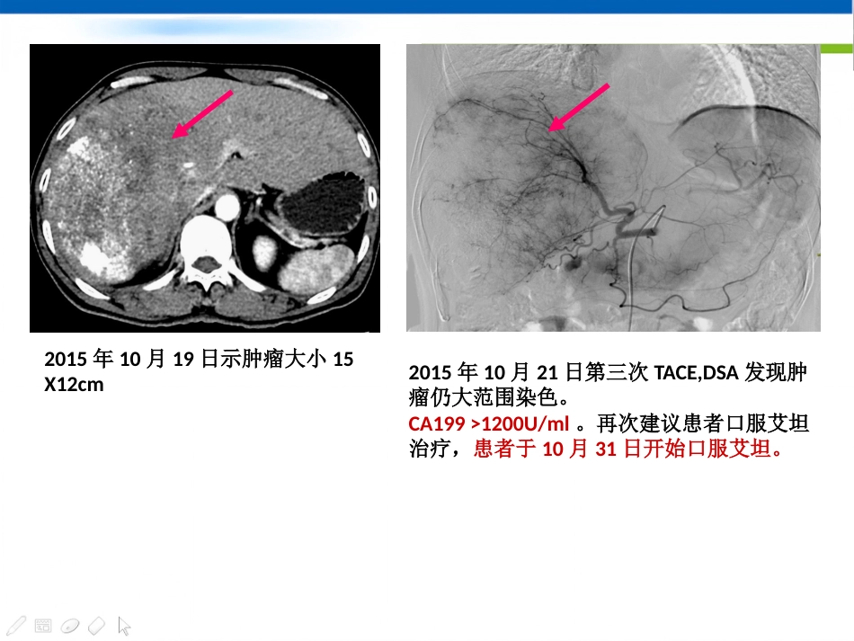 肝癌分子靶向治疗-郑传胜肝癌研讨会幻灯_第14页