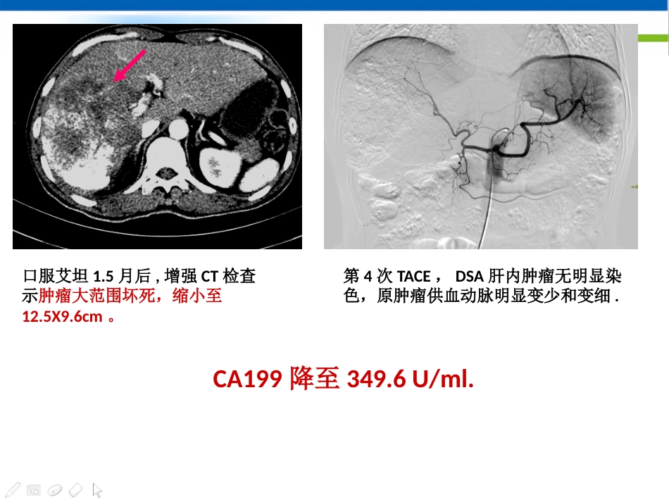 肝癌分子靶向治疗-郑传胜肝癌研讨会幻灯_第15页