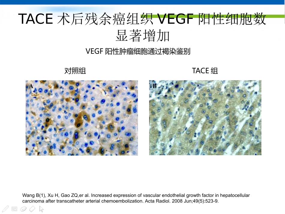 肝癌分子靶向治疗-郑传胜肝癌研讨会幻灯_第5页