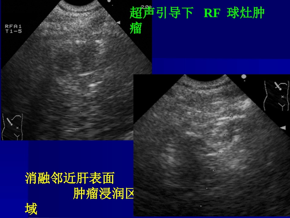 肝癌策略及疗效_第11页