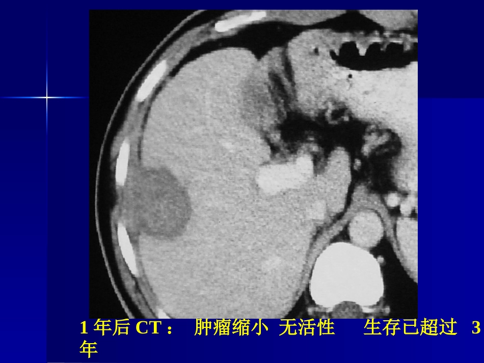 肝癌策略及疗效_第12页