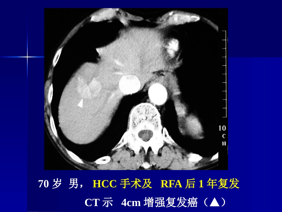 肝癌策略及疗效_第14页