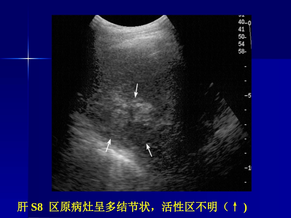 肝癌策略及疗效_第15页