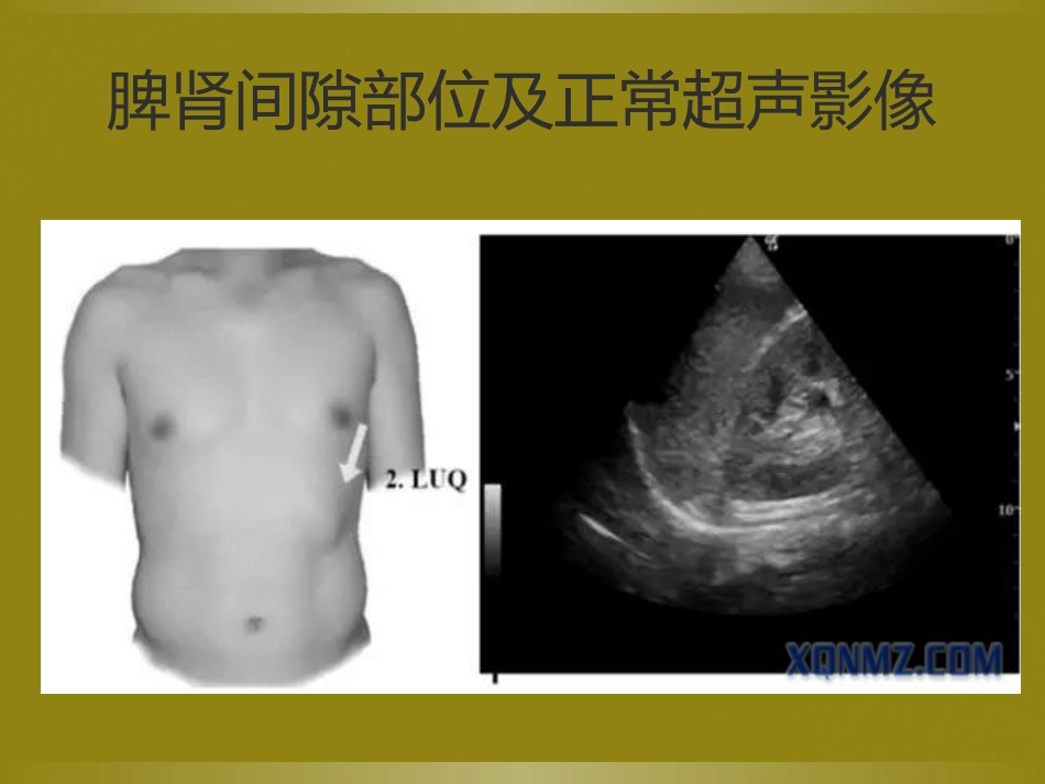 床旁超声FAST介入超声_第10页