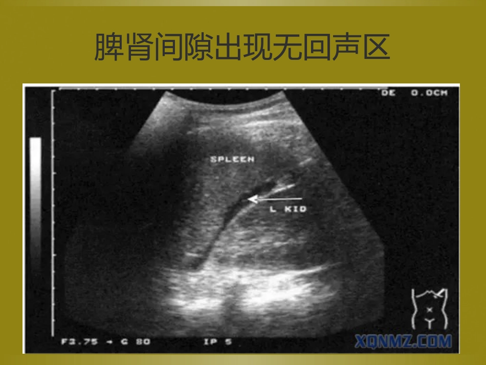 床旁超声FAST介入超声_第11页