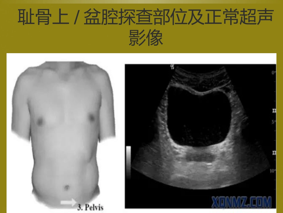 床旁超声FAST介入超声_第12页