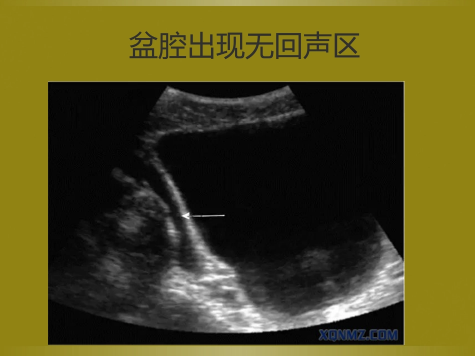 床旁超声FAST介入超声_第13页