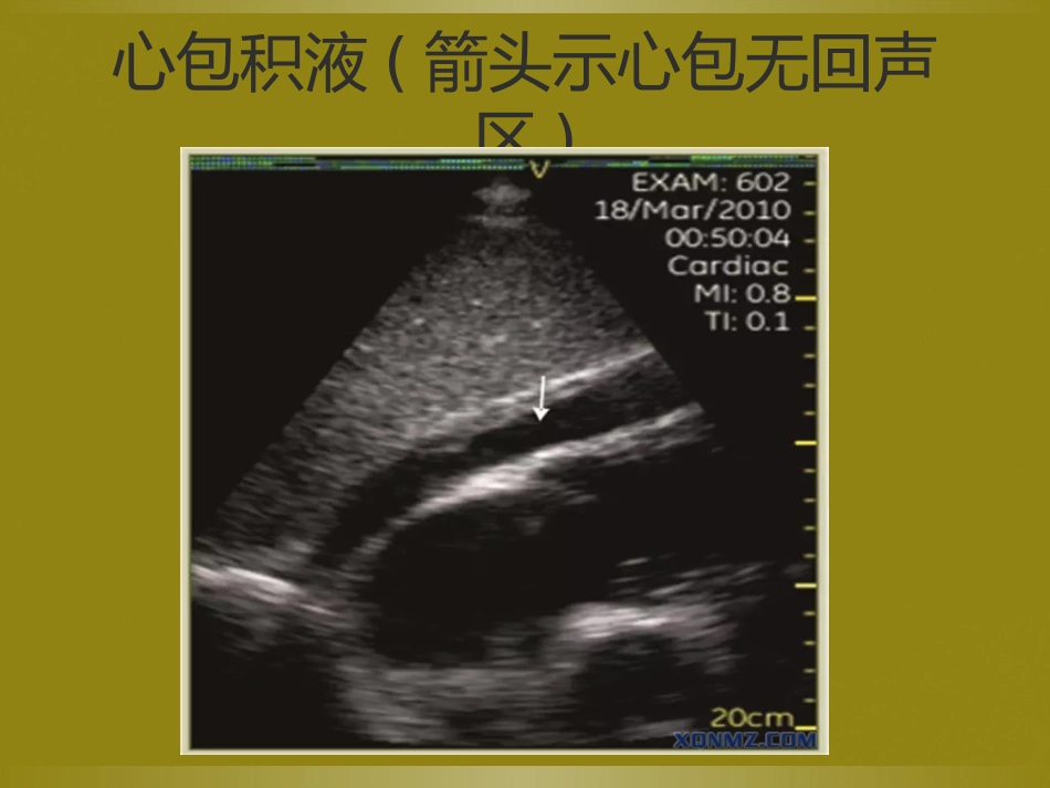 床旁超声FAST介入超声_第14页