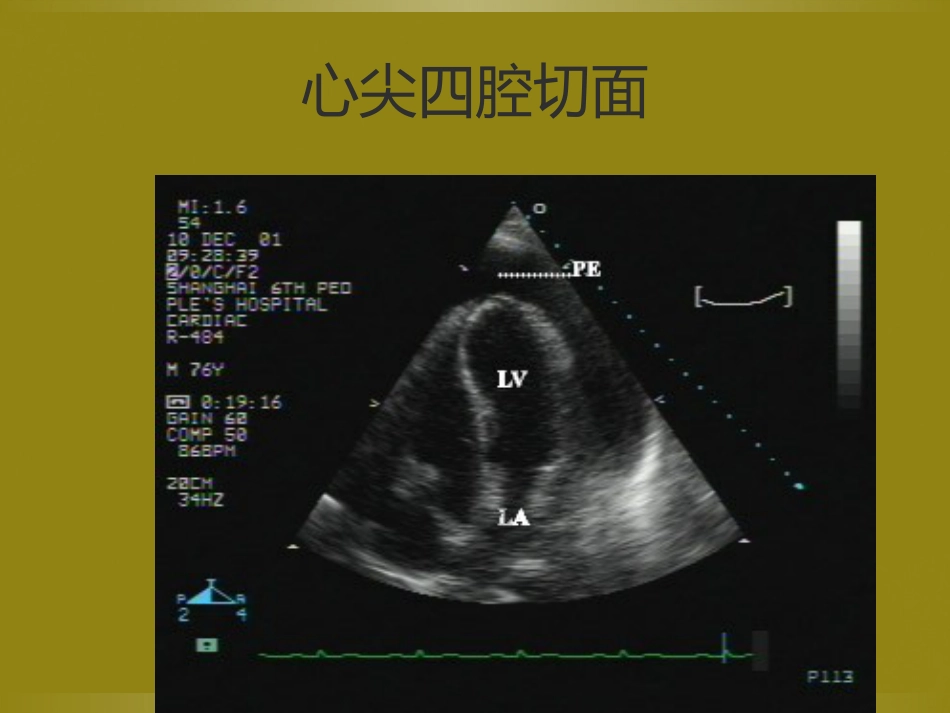床旁超声FAST介入超声_第15页