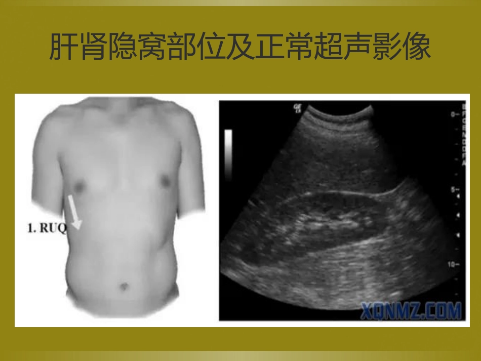 床旁超声FAST介入超声_第8页