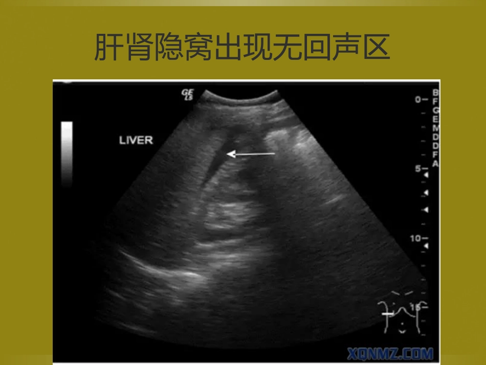 床旁超声FAST介入超声_第9页