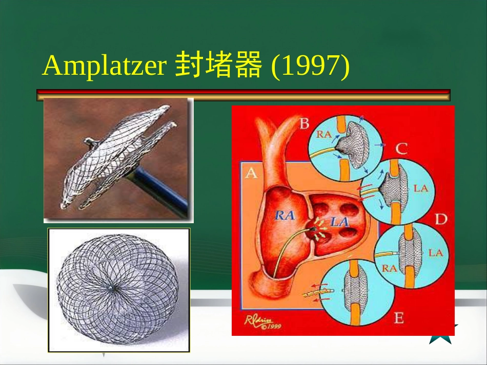 房间隔缺损介入治疗_第12页
