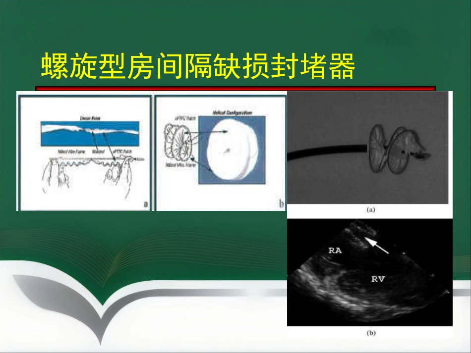 房间隔缺损介入治疗_第14页