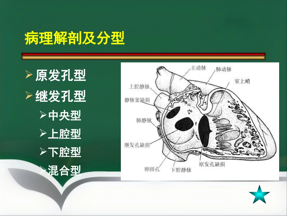 房间隔缺损介入治疗_第2页