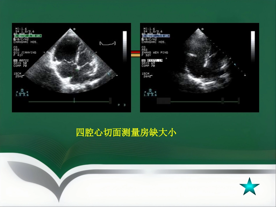 房间隔缺损介入治疗_第6页