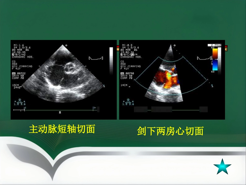 房间隔缺损介入治疗_第7页