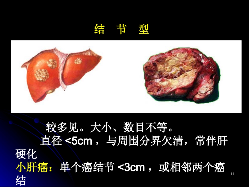 肝癌PPT参考课件_第11页