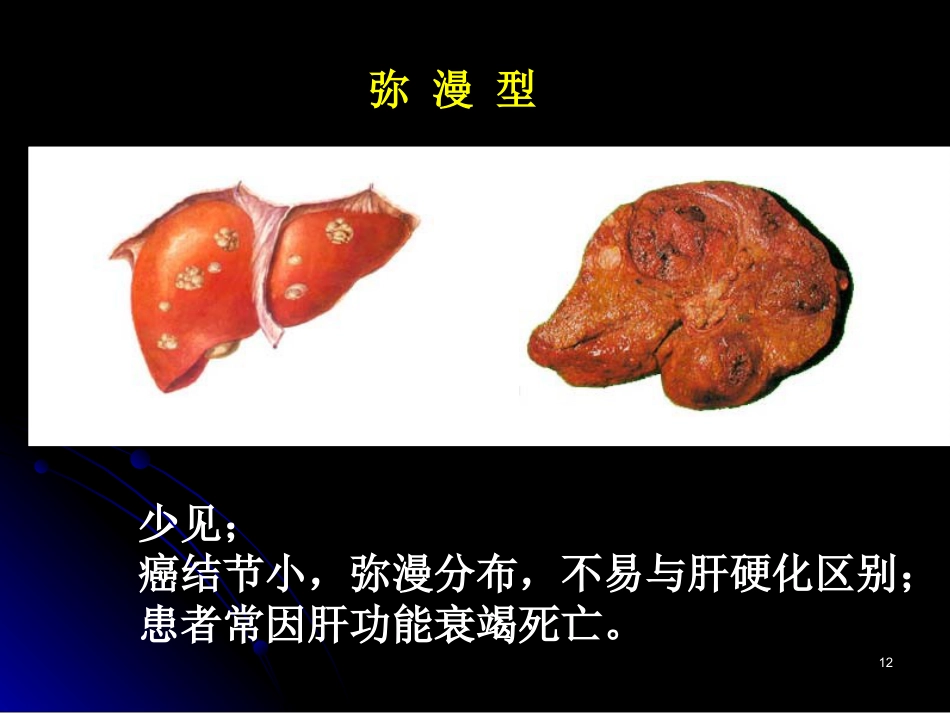 肝癌PPT参考课件_第12页