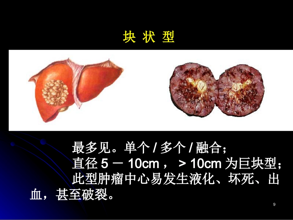 肝癌PPT参考课件_第9页