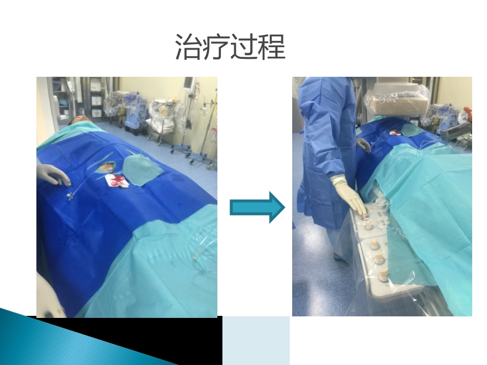 肝癌TACE护理ppt_第13页
