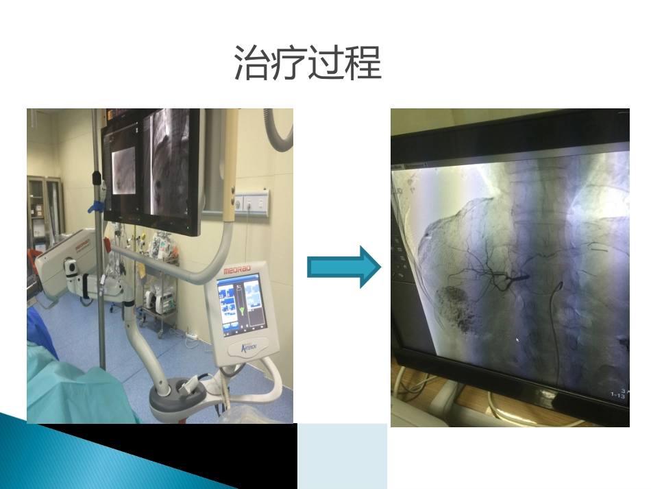 肝癌TACE护理ppt_第14页