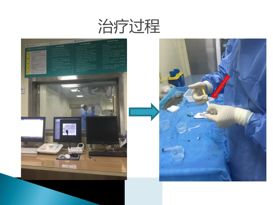 肝癌TACE护理ppt_第15页