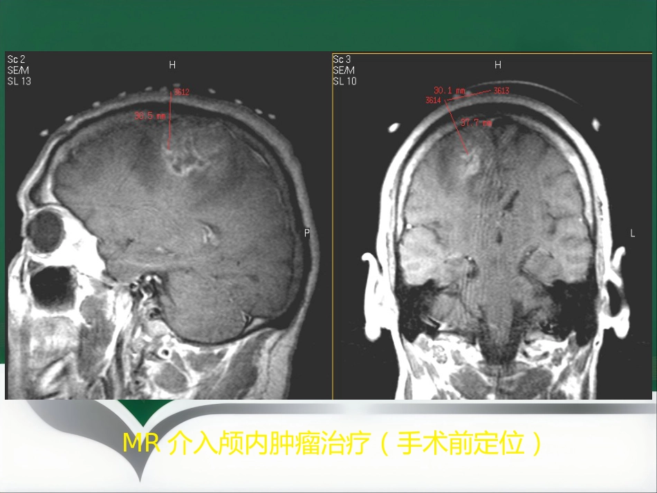 非血管性介入放射学_第12页