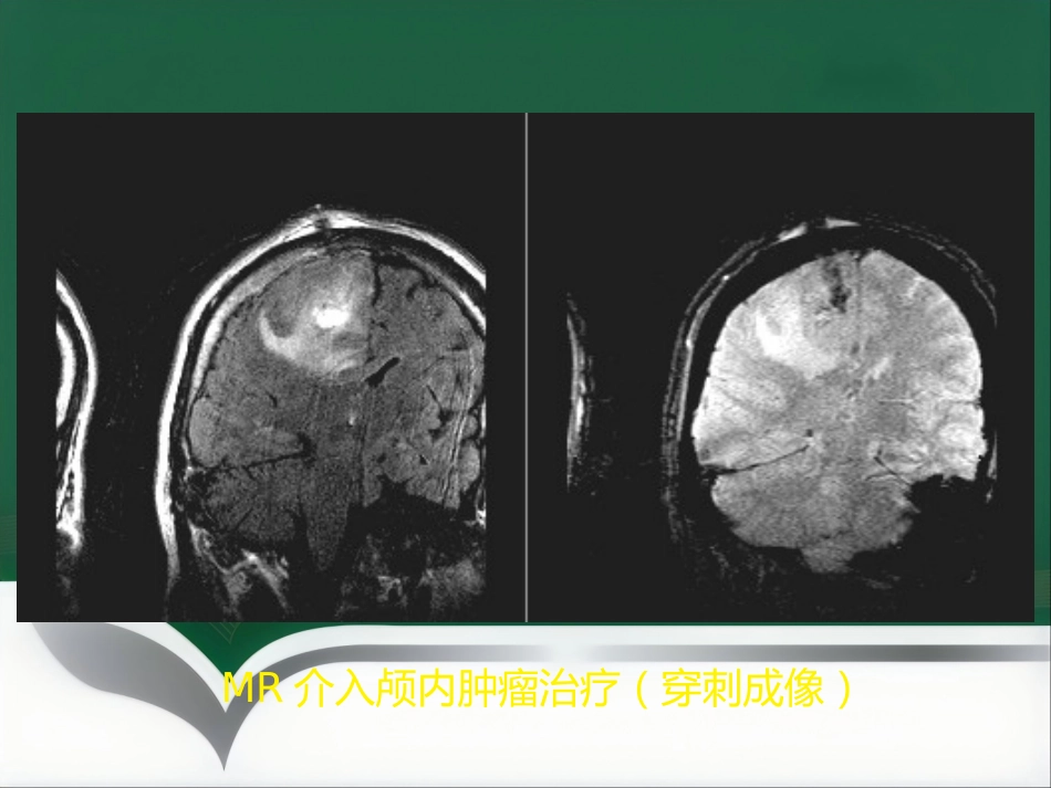 非血管性介入放射学_第13页