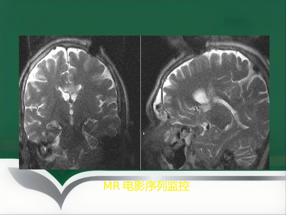 非血管性介入放射学_第14页