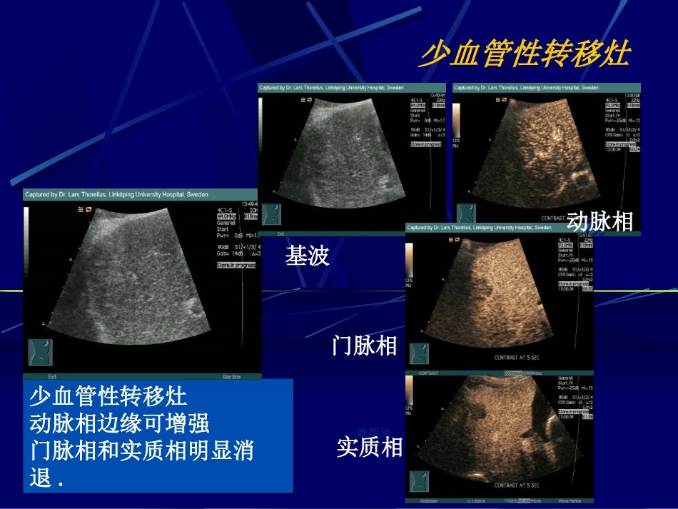 肝癌超声造影(1)_第10页