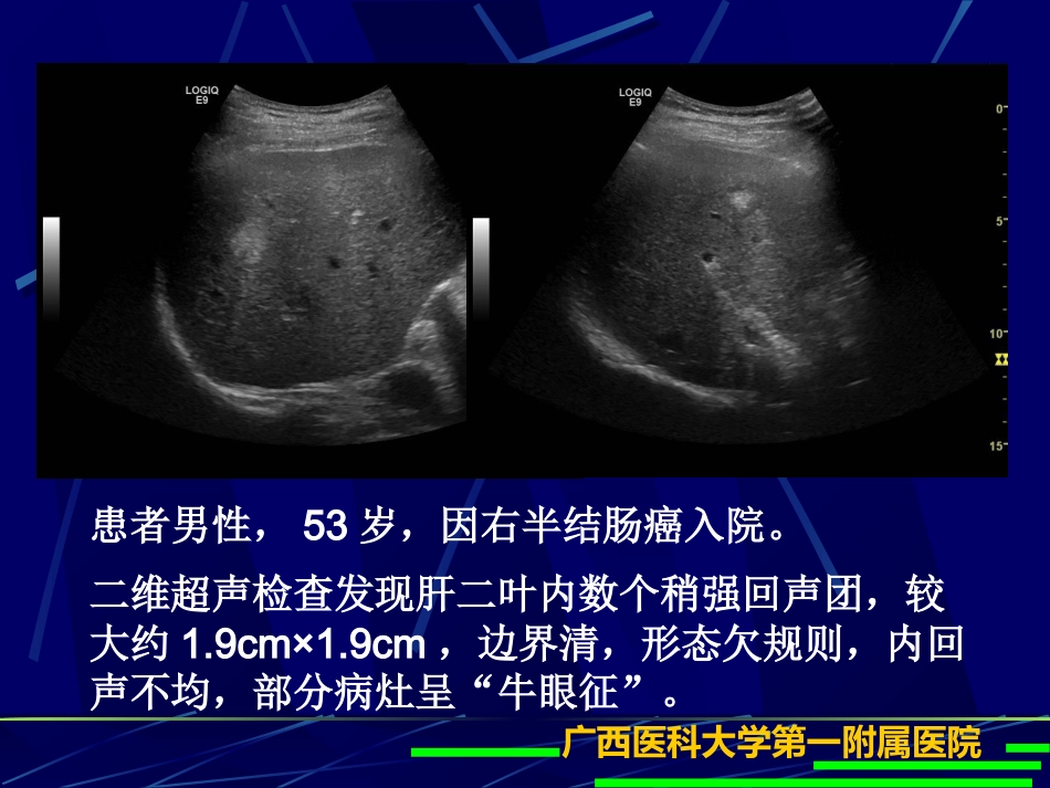 肝癌超声造影(1)_第12页