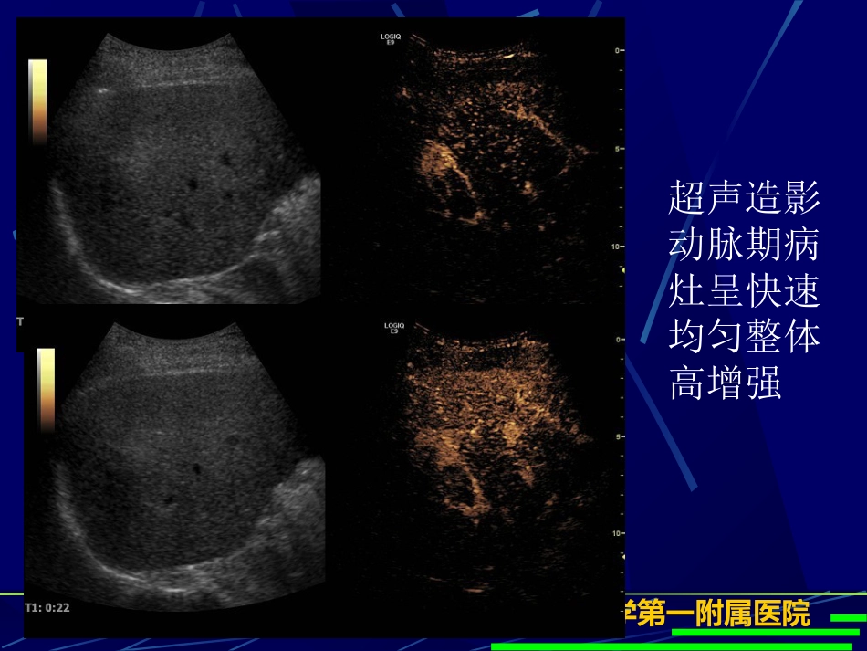 肝癌超声造影(1)_第13页