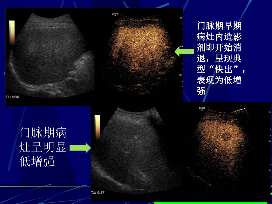 肝癌超声造影(1)_第14页