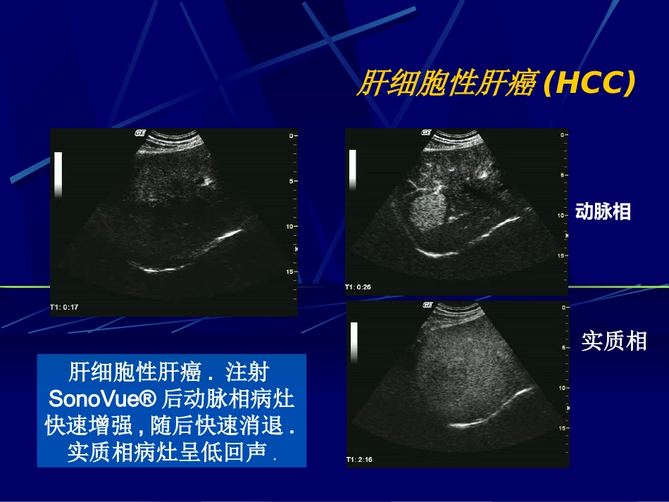 肝癌超声造影(1)_第5页