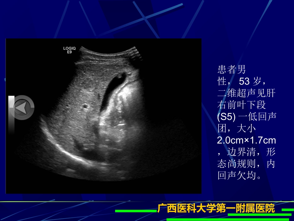 肝癌超声造影(1)_第6页