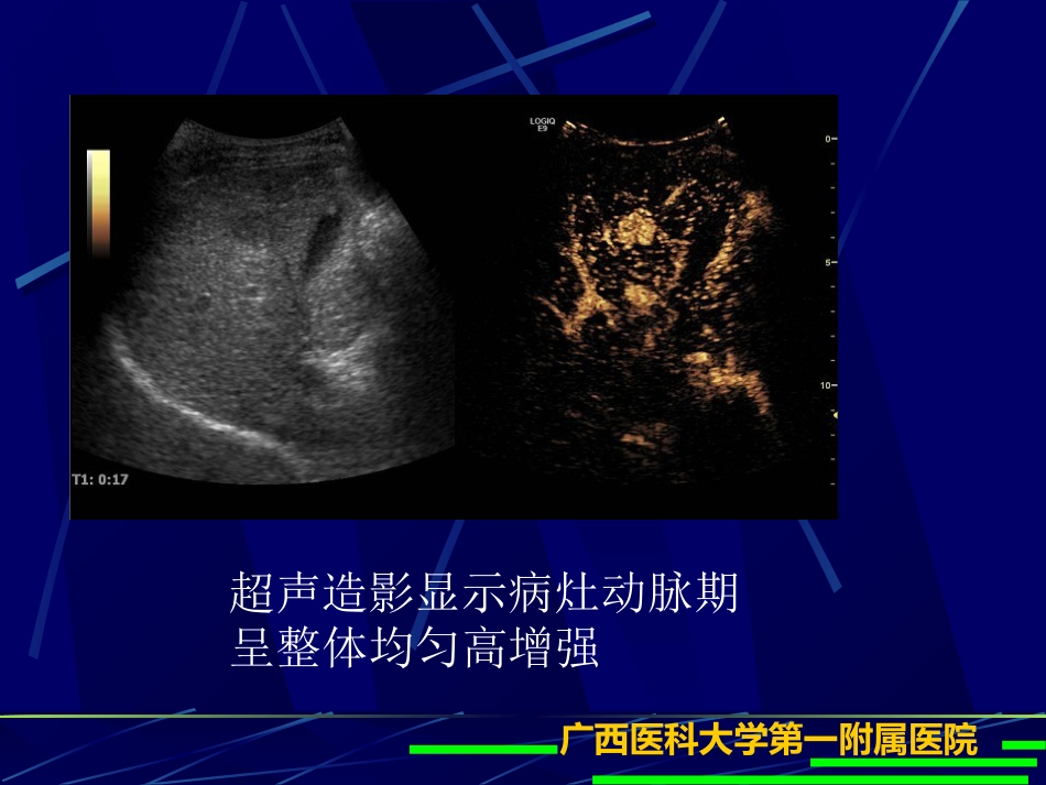 肝癌超声造影(1)_第7页