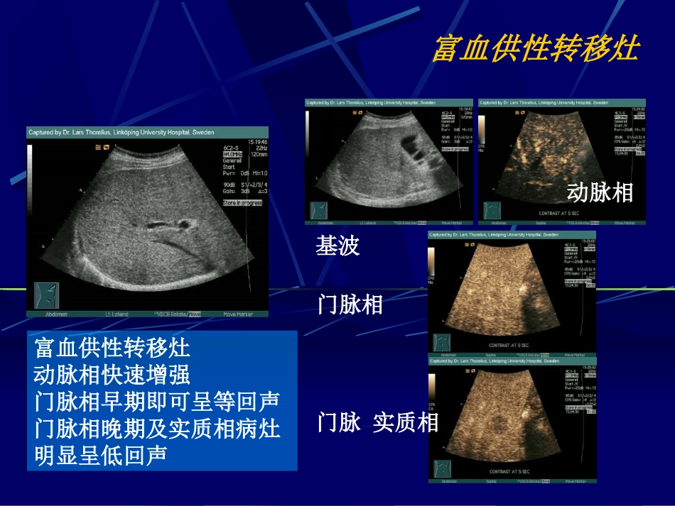 肝癌超声造影(1)_第8页