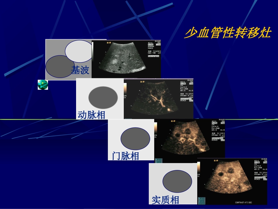 肝癌超声造影(1)_第9页
