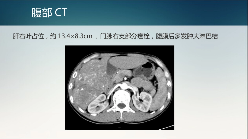 肝癌多学科协作(MDT)病例分享_14_第6页