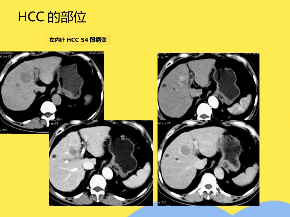 肝癌分期诊断(共53张PPT)_第10页