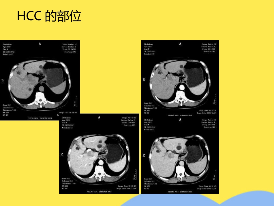 肝癌分期诊断(共53张PPT)_第11页