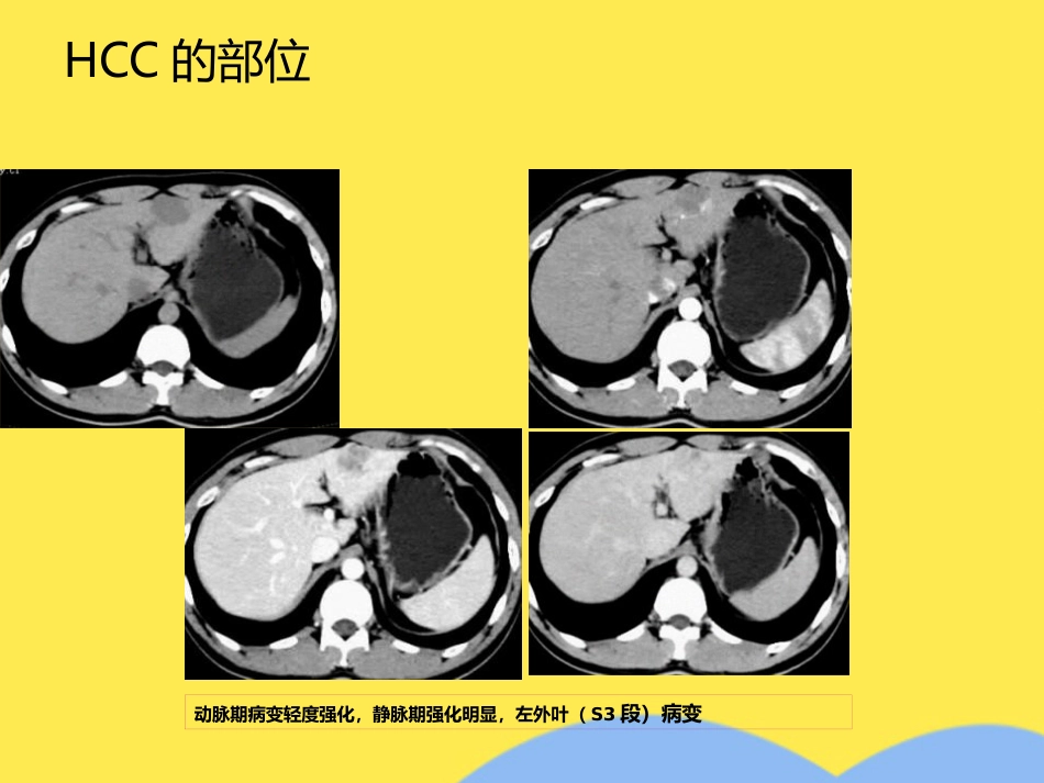 肝癌分期诊断(共53张PPT)_第12页