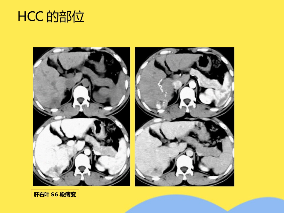 肝癌分期诊断(共53张PPT)_第13页