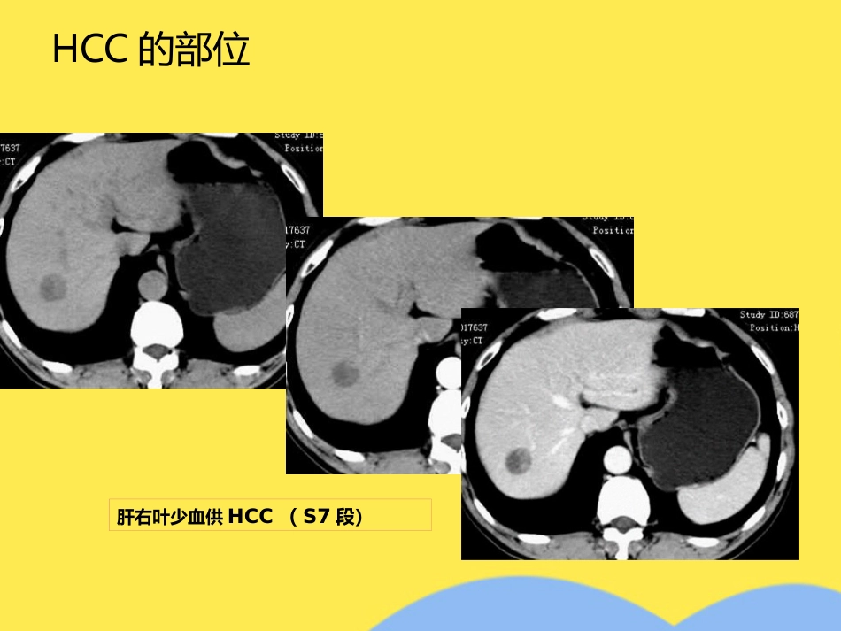 肝癌分期诊断(共53张PPT)_第14页