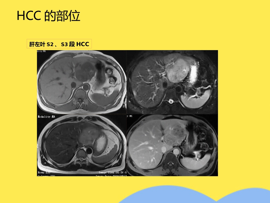 肝癌分期诊断(共53张PPT)_第15页