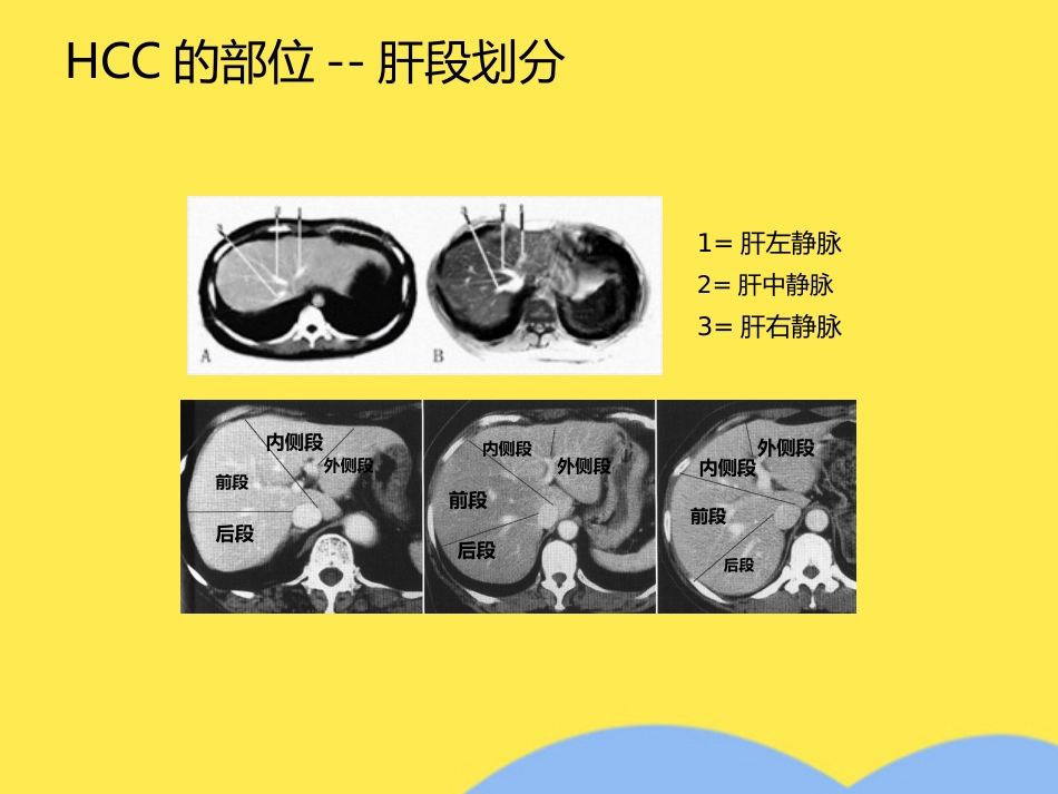 肝癌分期诊断(共53张PPT)_第8页