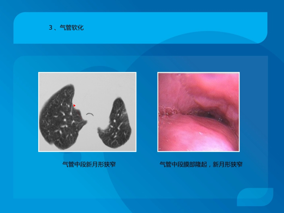 复杂气道疾病气管镜下介入治疗_第6页