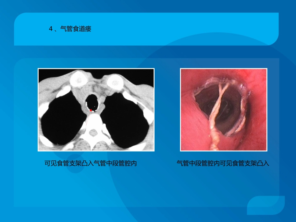 复杂气道疾病气管镜下介入治疗_第7页