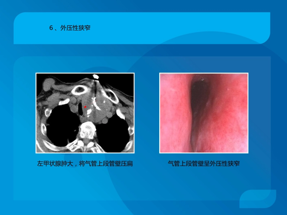 复杂气道疾病气管镜下介入治疗_第9页
